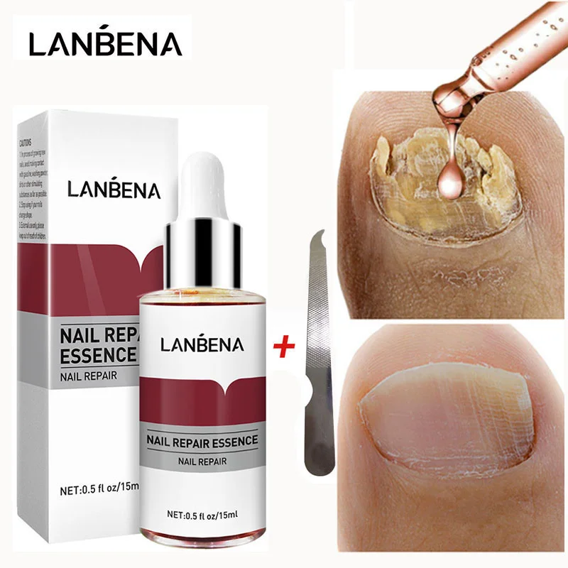 

LANBENA Nail Fungus Treatment Serum Gel Nail Polish Anti Foot Fungus Infection Cuticle Oil Foot Care Paronychia Onychomycosis