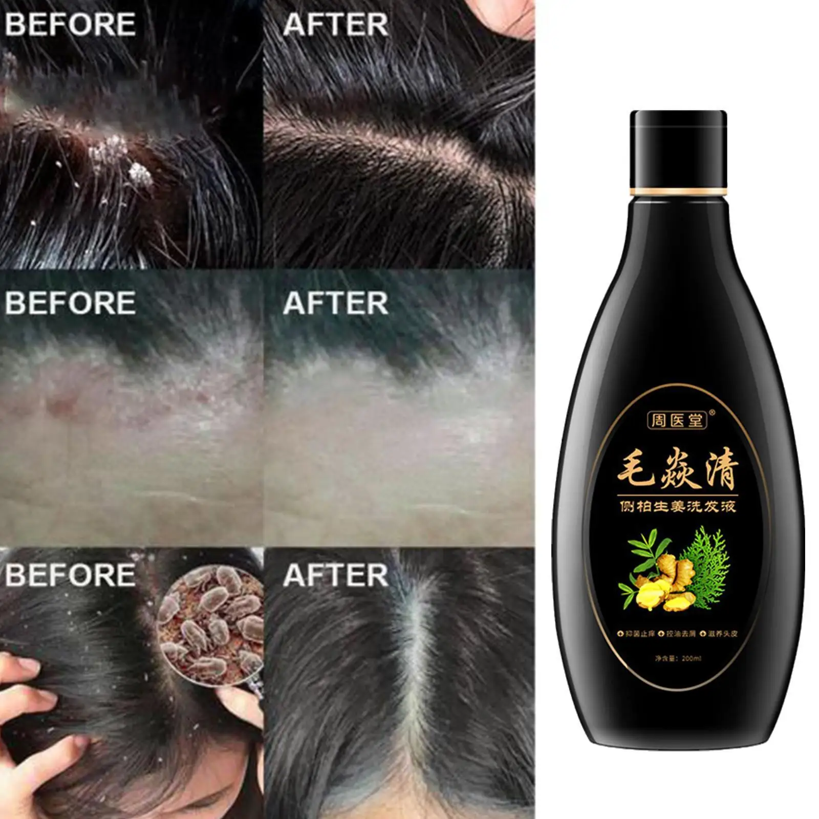 Scalp Cleansing Shampoo Skincare Product Scalp Hair Control Shampoo New Anti-itching Oil Follicle Antibacterial Psoriasis M C4S8