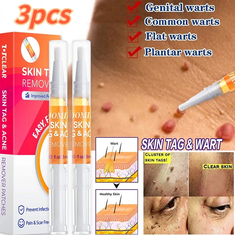Флуоресцентная ручка для удаления бородавок с кожей жидкая лечения папилломы 1