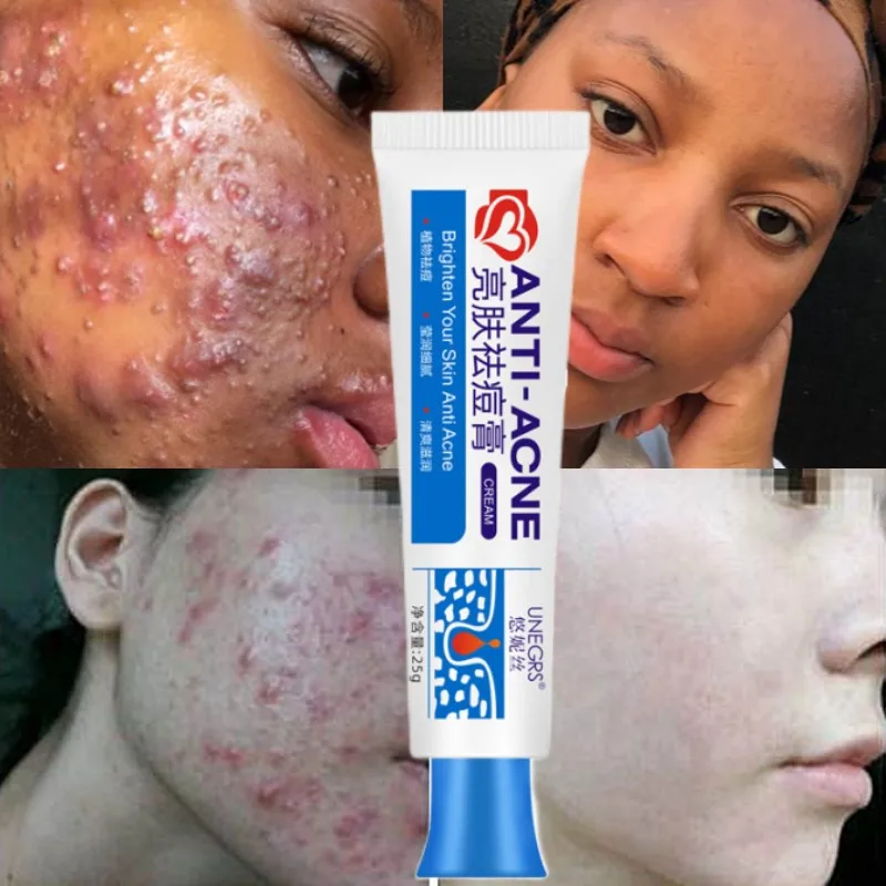 

New Powerful Acne Removal Face Cream Clears Pimple Scar Black Dots Gel Treat Severe Acne Shrink Pore Whiten Skin Care Ointment