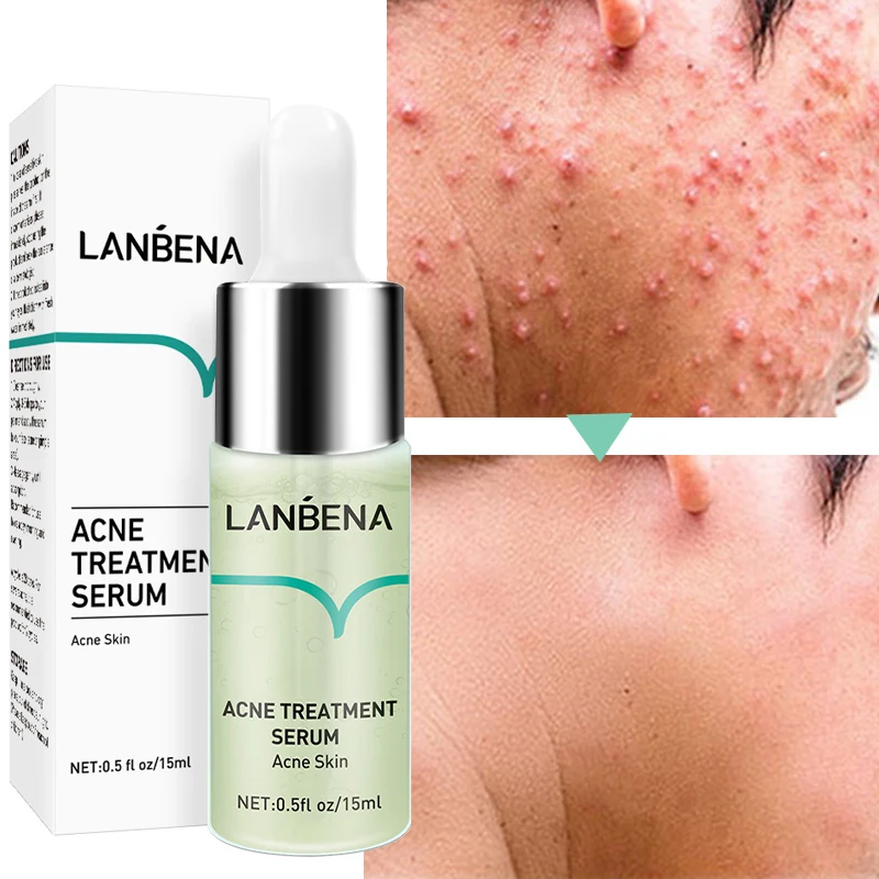 

LANBENA Acne Treatment Face Serum Anti Pimples Spots Scars Removal Essence Shrink Pores Oil Control Repair Skin Care Products