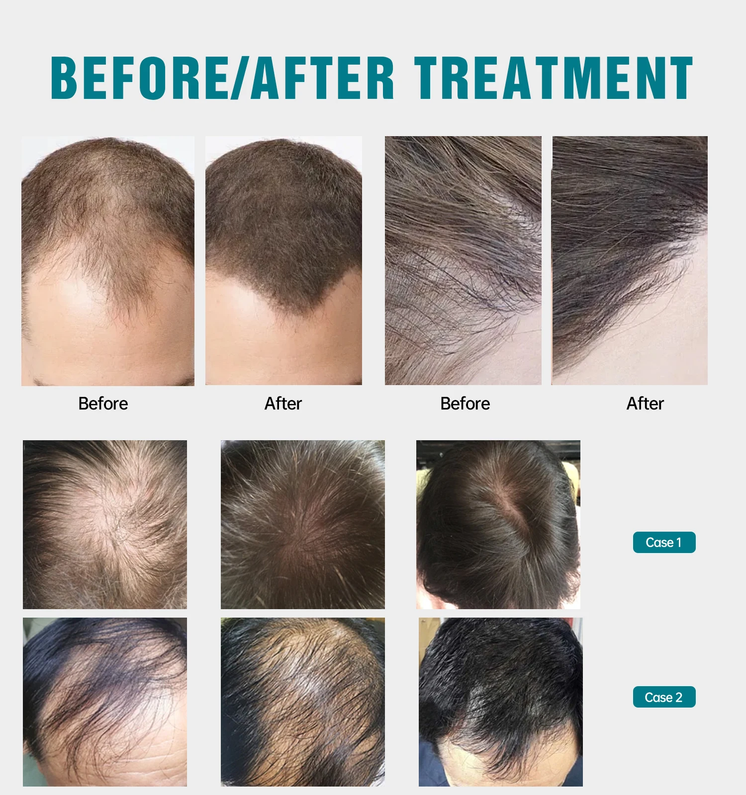 Для продавца OEM/ODM лазерный колпачок оборудование для ухода за кожей головы 650 нм