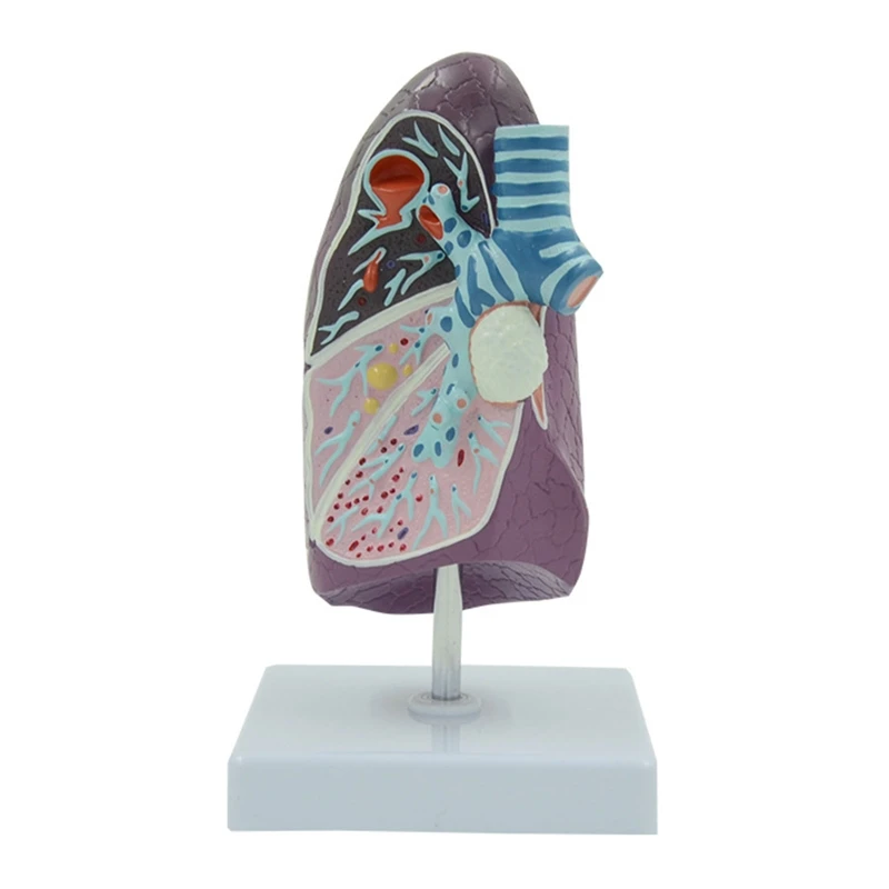 

Lung Anatomy Model for Pulmonary Study Pathological Lung Anatomy Model U4LD