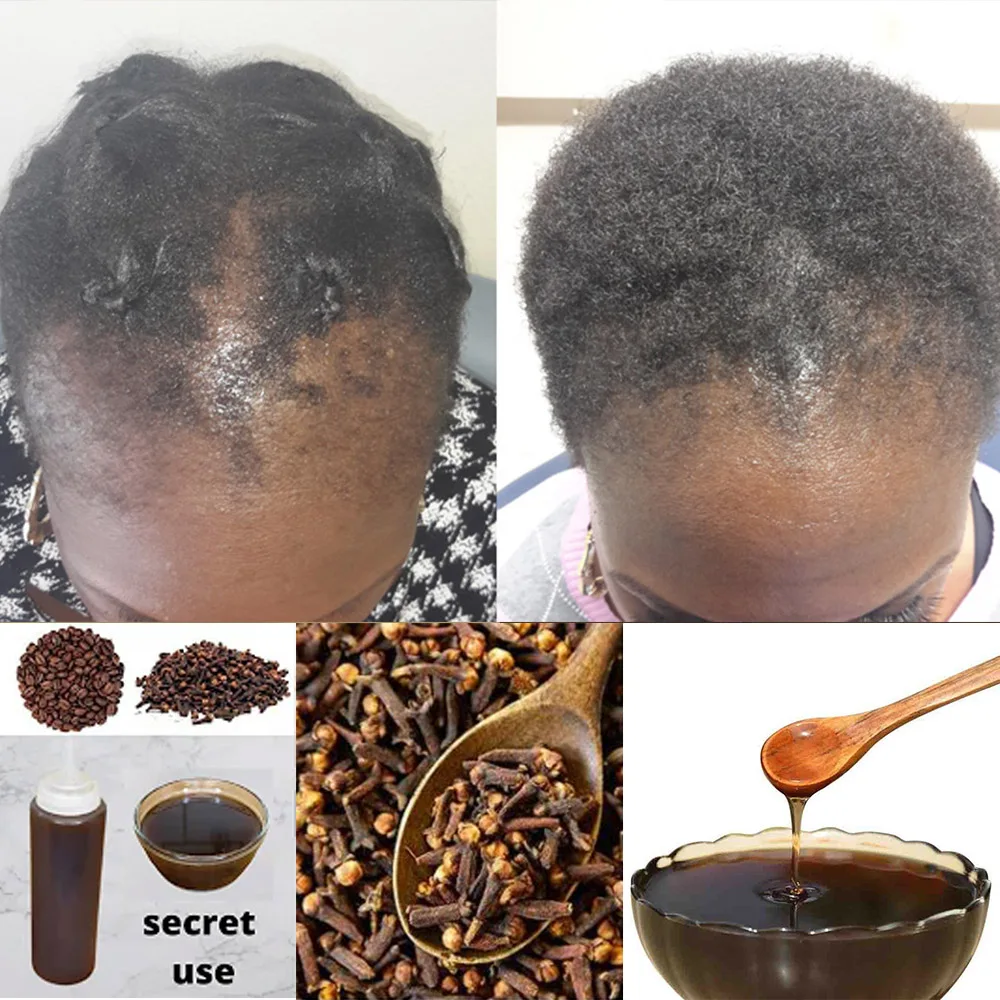 Africa Women Traction Alopecia Treatment Hair Loss Treatment Get Rid of Wigs Hair Growth Product for Men Shampoo 300ml Hair Care