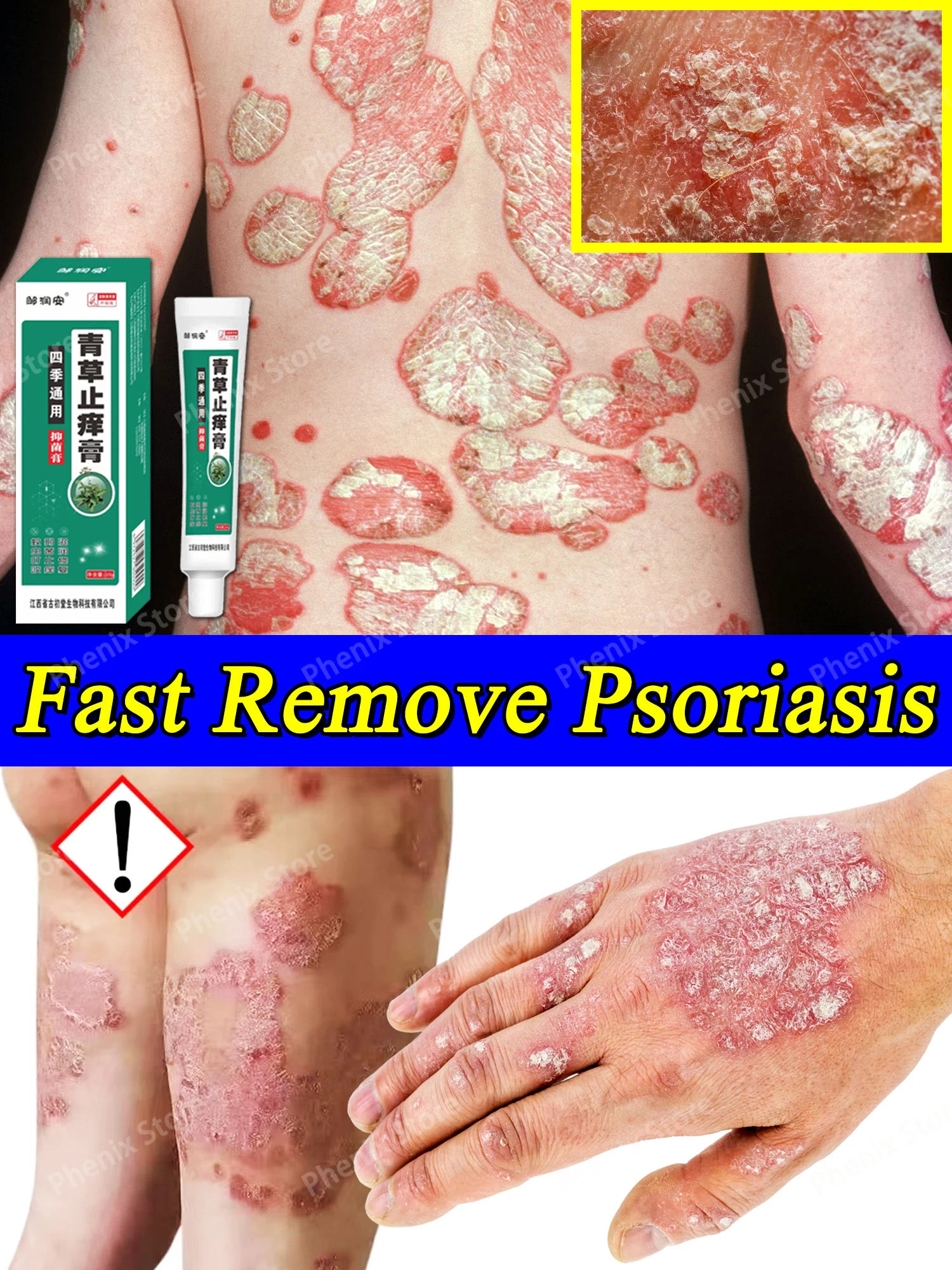 

Травяные антибактериальные крем от псориаза, мазь для быстрого лечения, избавление от зуда, экзома, сыпь, крапивница, удаление акне