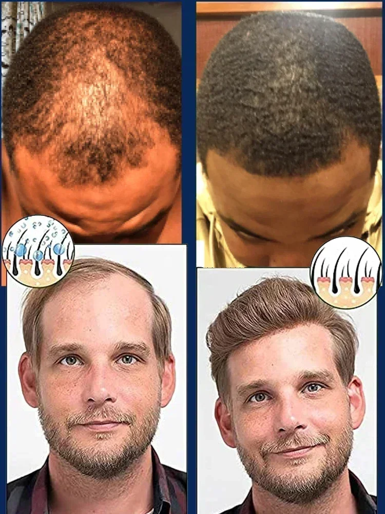 Рост волос для мужчин и женщин имбирное натуральное масло роста уход за волосами