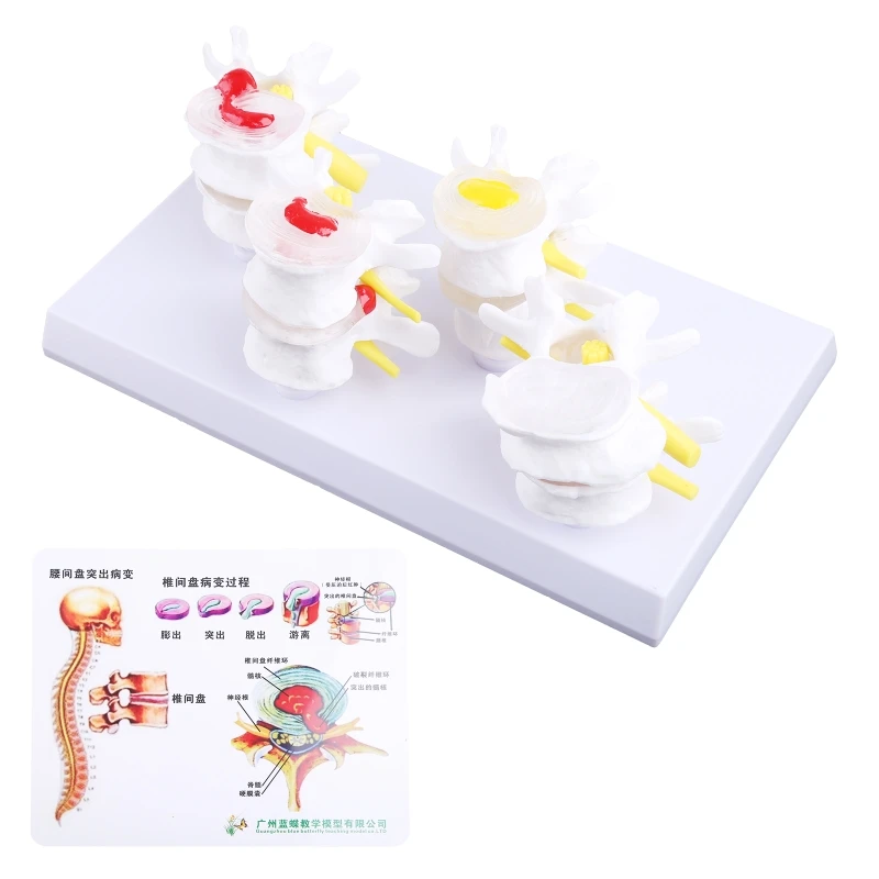 

1 Set Human Lumbar Lesion Spine Statue Display Model Medical Teaching Learning