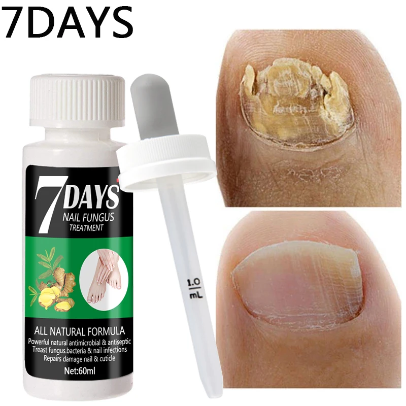 

Fungal treatment foot care essence, the best nail repair, prevents fungal growth, repairs and renews damaged and damaged nails