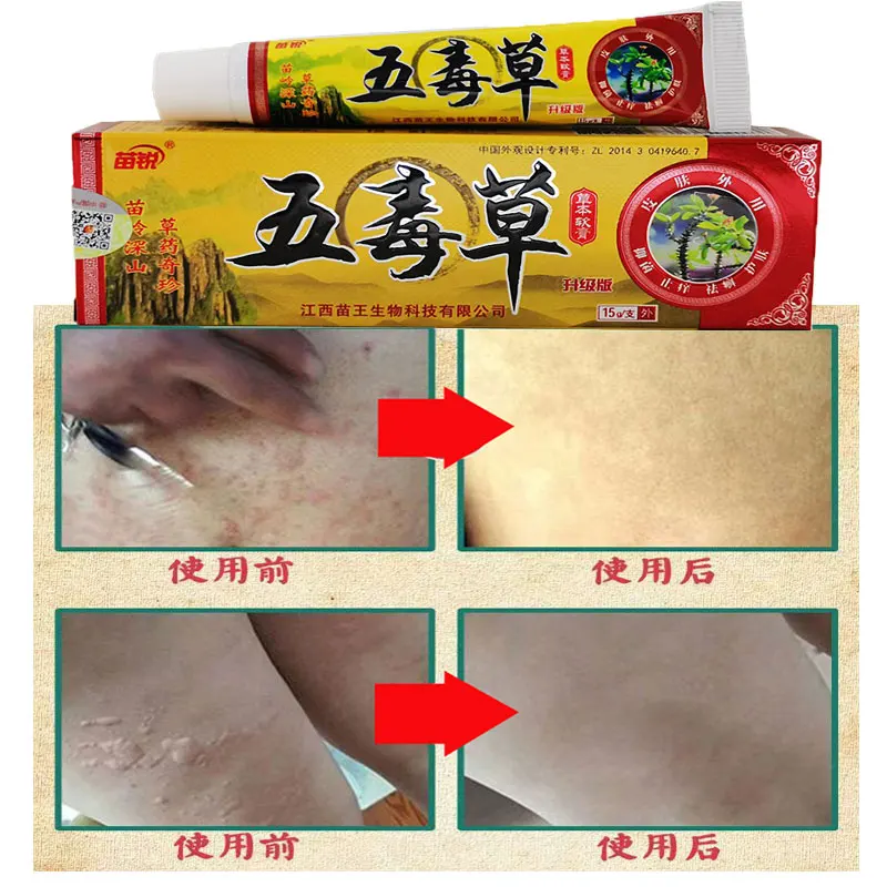 

Herbal Body Health Psoriasis Dermatitis Eczema Pruritus Psoriasis Ointment China Creams Ointment Facial Skin Care