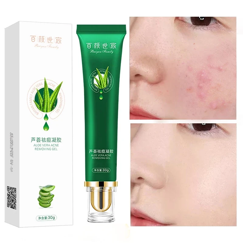 Aloe Vera Anti-acne Gel Effectively Removes Acne Fades Acne Oil Control Pores Whitening And Moisturizing Skin Care 30g