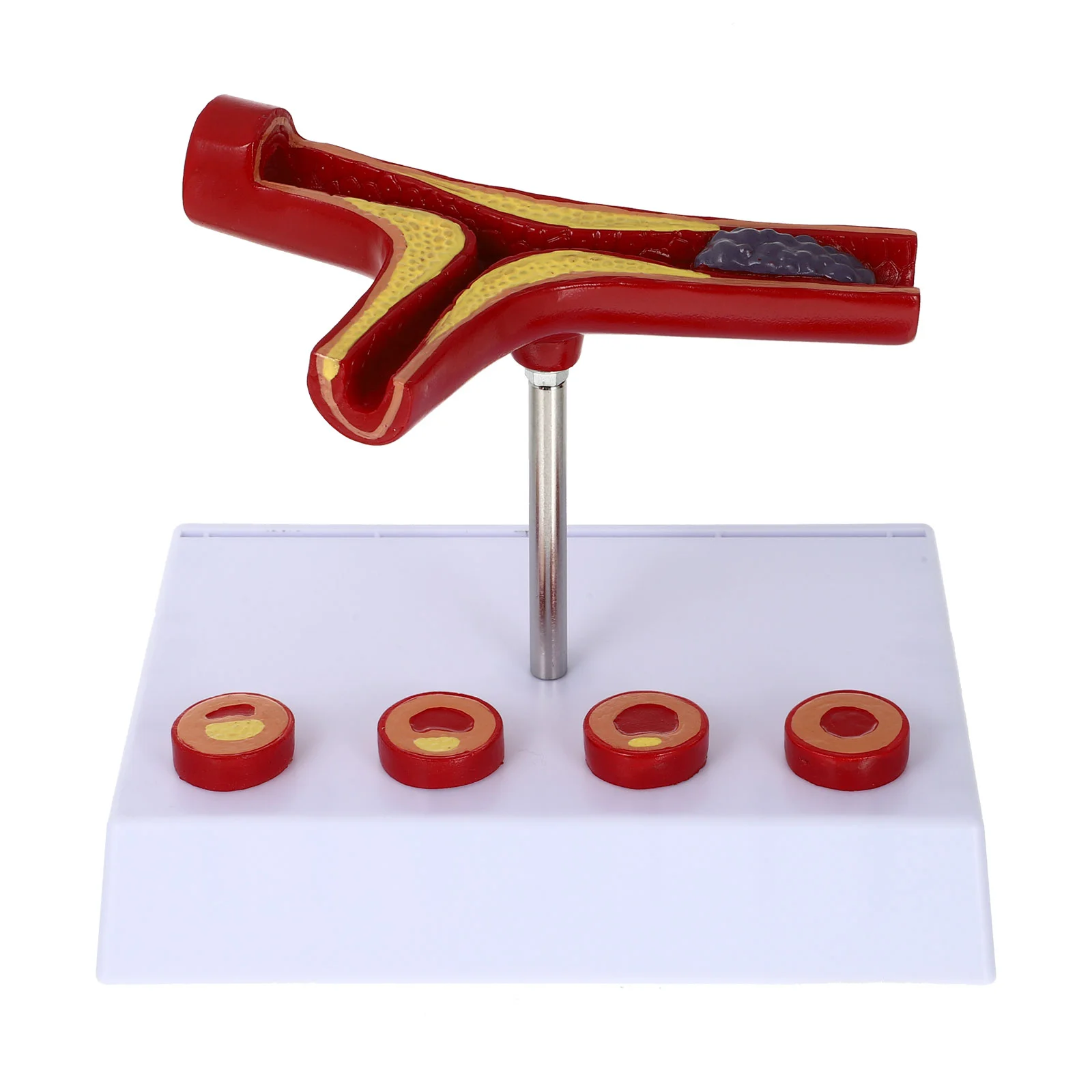 

Atherosclerosis Medical Model Blood Vessel Anatomical Model Cardiovascular Model