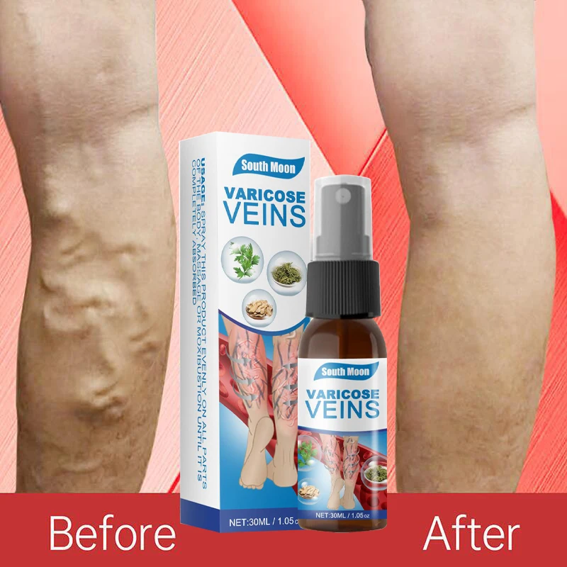 

30ml Varicose Vein Spray Vasculitis Phlebitis Spider Legs Smoothing Blood Vessel Bulging Treatment Redness Herbal Leg Body Care