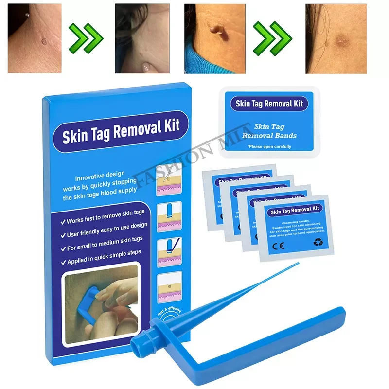 

use skin tags remover kit remove warts body skin care tools wart treatment face Skin Tag Removal Tool Acne Tag Remover band