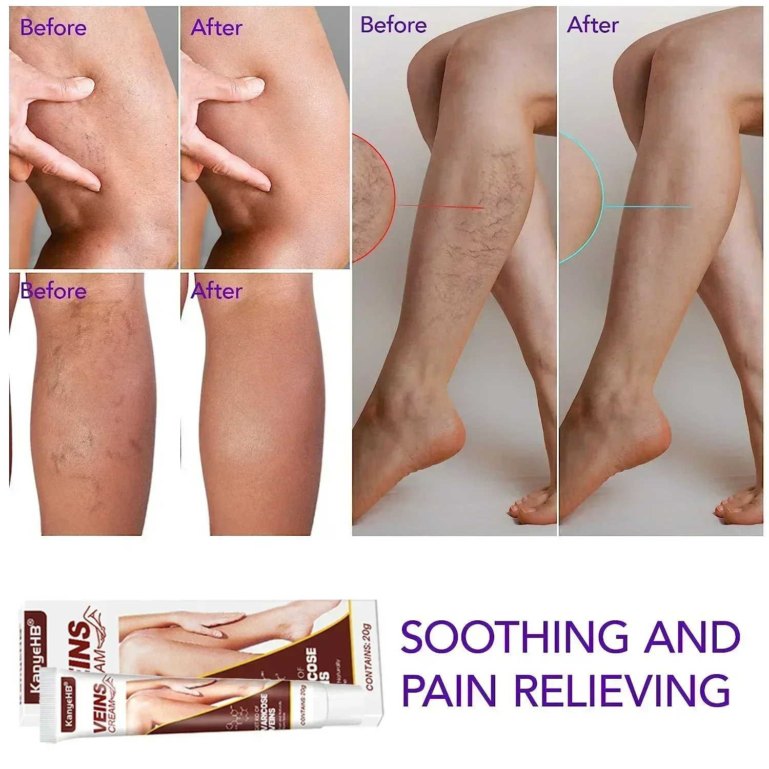 Крем-паук для лечения варикозного расширения вен