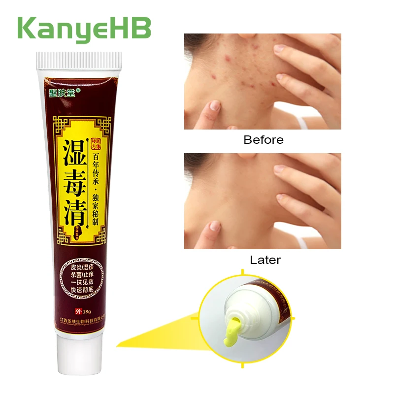 

1pcs Psoriasis Treatment Cream Eczema Dermatitis Herbal Essence Itching Antibacterial Ointment From Psoriasis Beauty Health S026