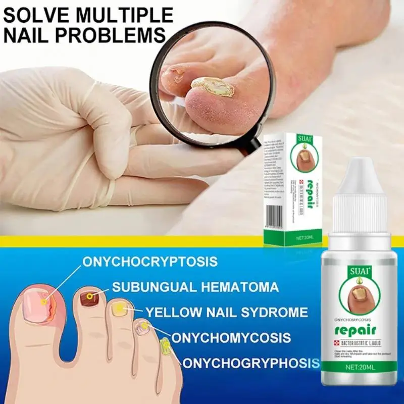 

Nail Treatments Feet Care Serum Nails Fungus Foot Toe Fungal Removal Gel Anti Onychomycosis Repair Paronychia