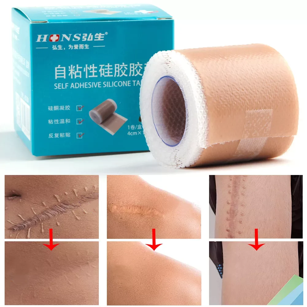 

4x150cm Scar Band Removal Patches Silicone Gel Therapy Patch Acne Trauma Burn Scar Skin Repair Efficient Surgery Scar Treatment