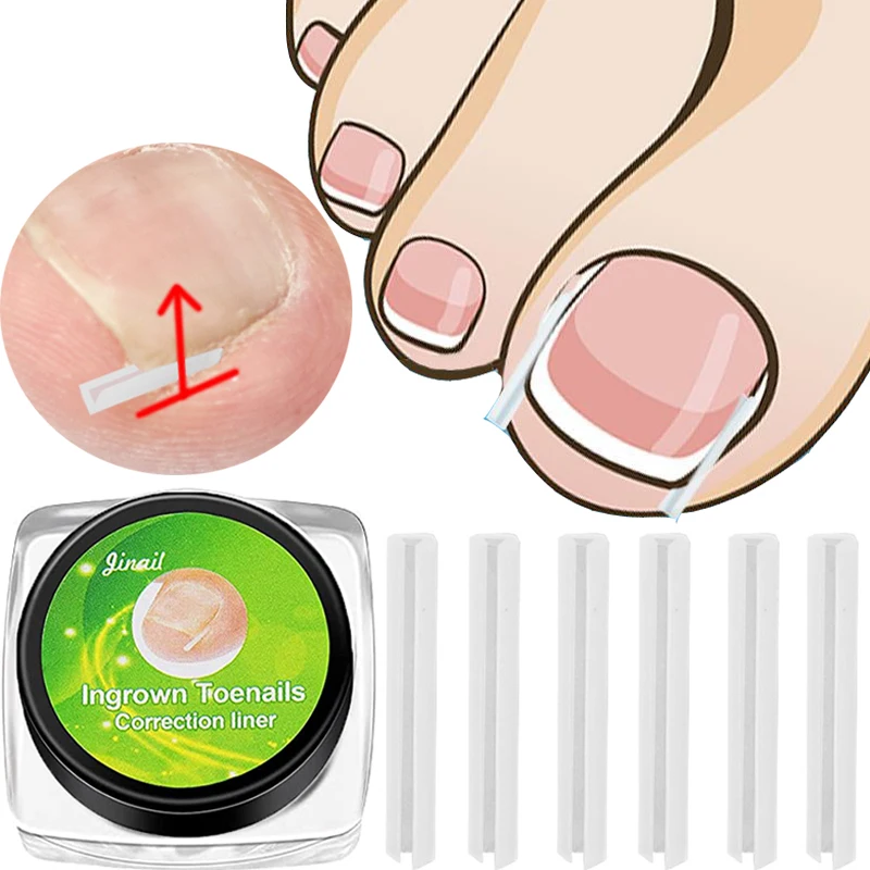 

10pcs Ingrown Toenail Correction Tool Ingrown Toe Nail Treatment Elastic Patch Sticker Straightening Clip Brace Pedicure Tools