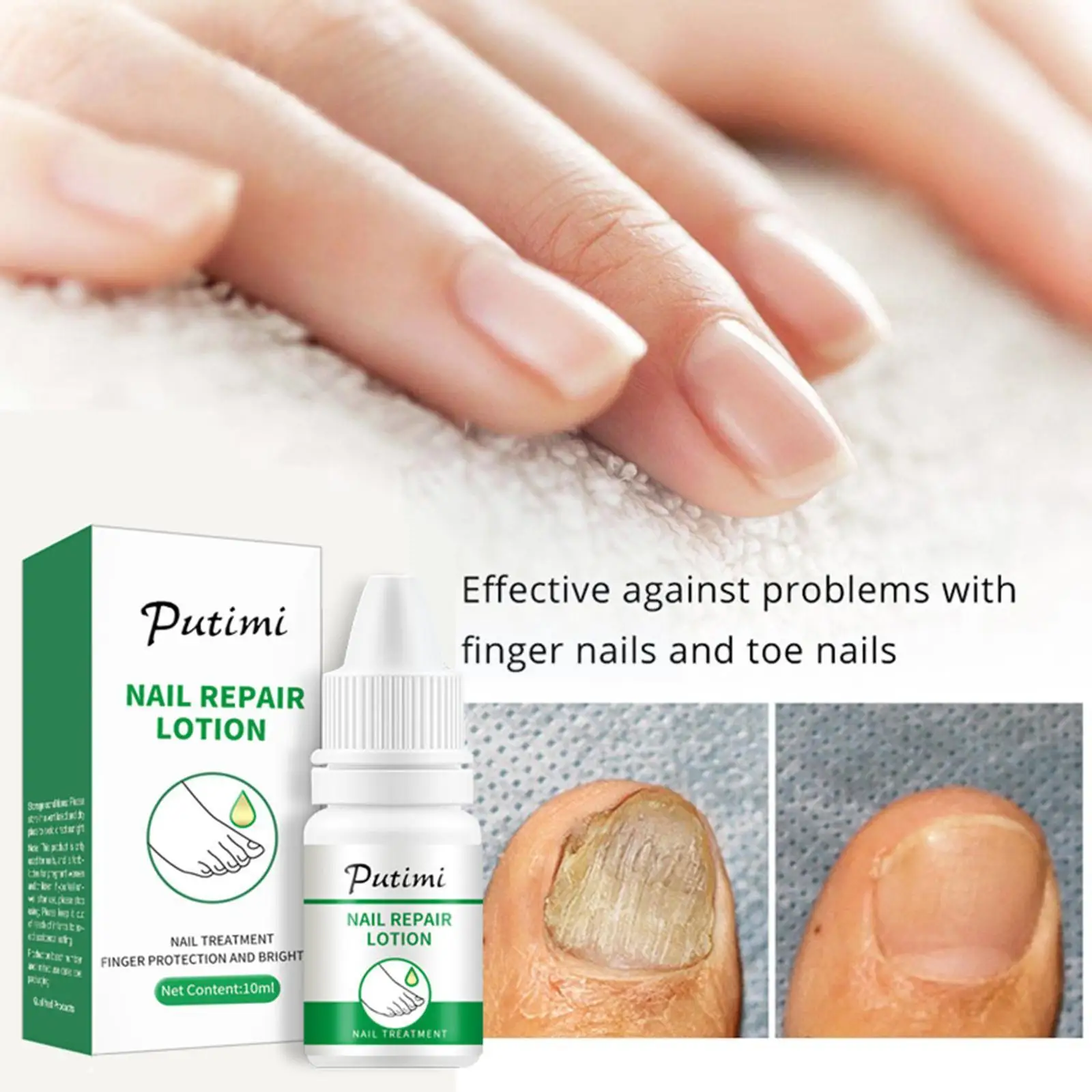 

Nail Fungal Treatment Feet Care Essence Serum Anti Toenail Care Infection Paronychia Foot Gel Onychomycosis Foot Fungus Rem U0X4