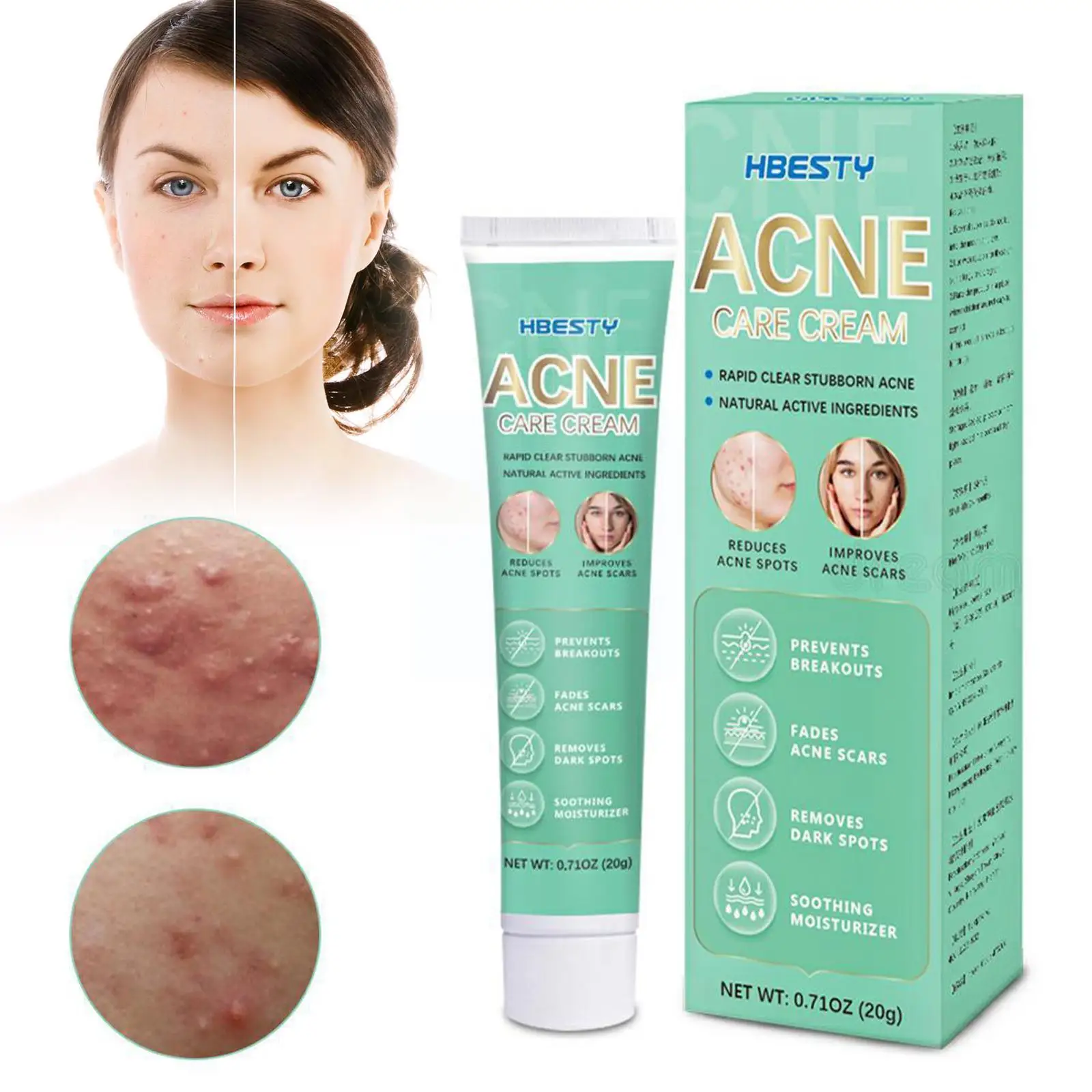 

20g Herbal Acne Treatment Face Cream Anti-Acne Gel Mark Acne Eliminate Face Pores Shrink Whitening Removal Care Pimples P7N5
