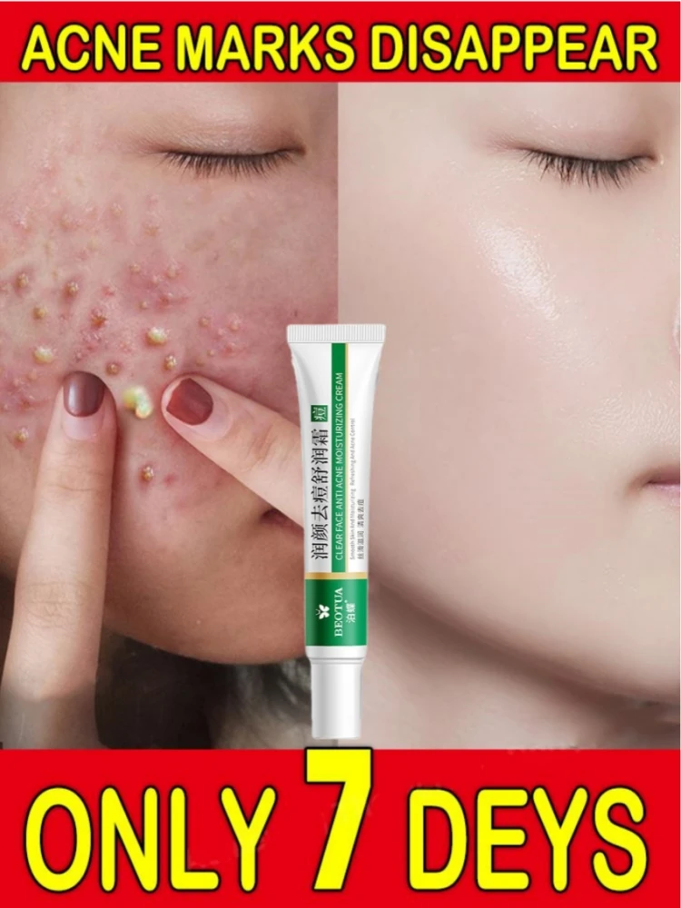 Acne Cream to Eliminate Acne Remove Acne Marks Herbal Extract Efficient Anti-inflammatory Skin Repair Moisturize Facial Care Gel