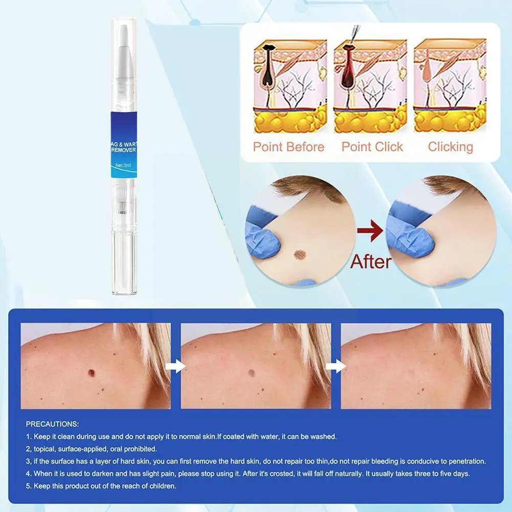 

Wart Remover Care Solution Mole Skin Tag Removal Solution Removal Skin Dark Mole Face Freckle Removal Spot Cream Painless H4Z1