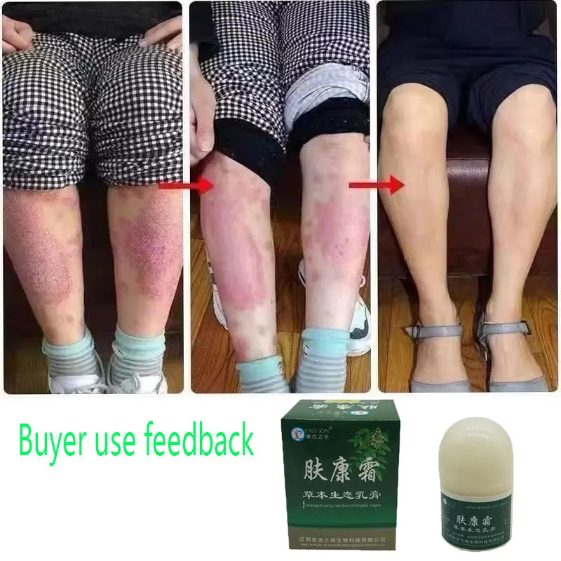 

Psoriasis CreamDermatitis Anti Fungal Infection Anti-itch Herbal Effective Antibacterial Eczema Cream