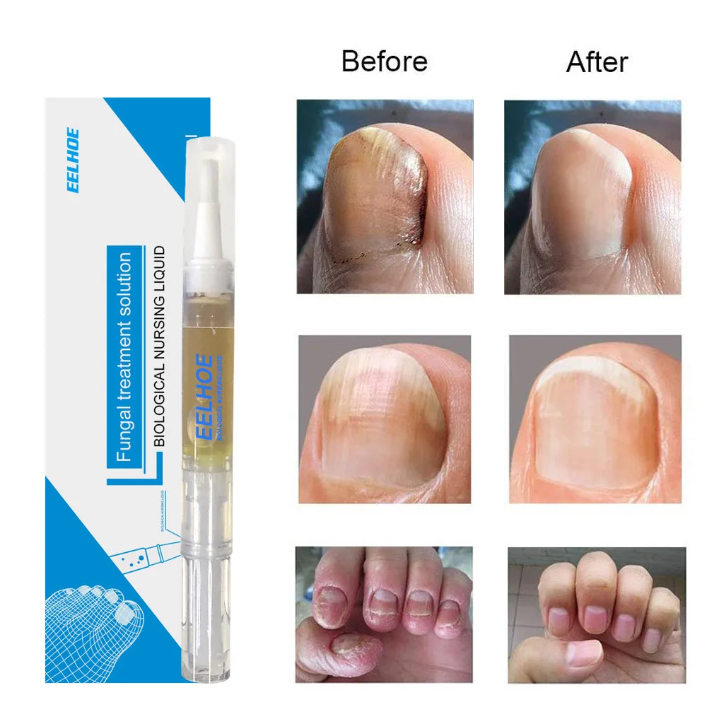 Сыворотка для восстановления ногтей Nail fungal solution. Ремонт ногтя. Средство от грибка ногтей fungal Nail Renewal. Смарт масло для ногтей от грибка