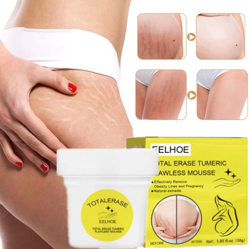 

30G Pregnancy Repair Stretch Mark Removal Removal Acne Scar Stretch Marks Cream Fat Striae Gravidarum Treatment Body Creams