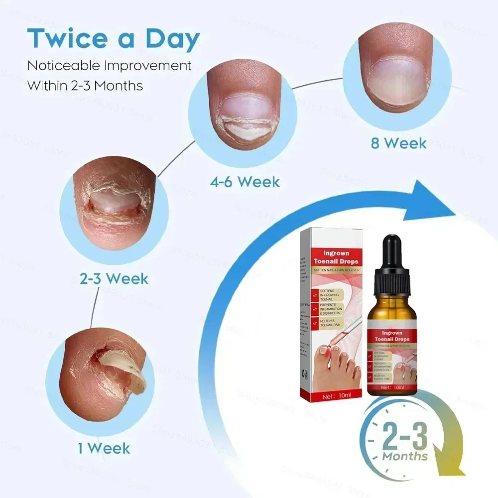 Масло от грибка ногтей удаление на ногах ремонт онихомика антиинфекционный гель