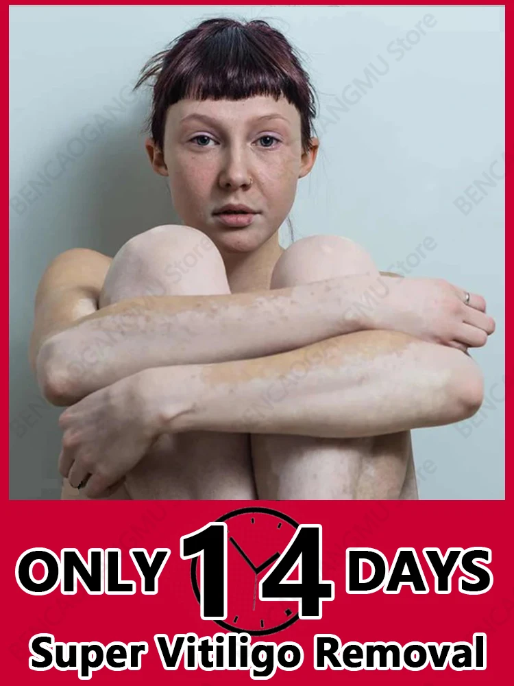 

Средство для удаления и удаления виноградных костей, лучшие продукты от виноградных костей, натуральные растительные экстракты для удаления виноградных костей