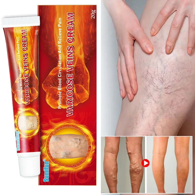 

Herbal Varicose Veins Treatment Cream Repair Vasculitis Phlebitis Spider Pain Relief Ointment Effective Relieve Tired Legs Care
