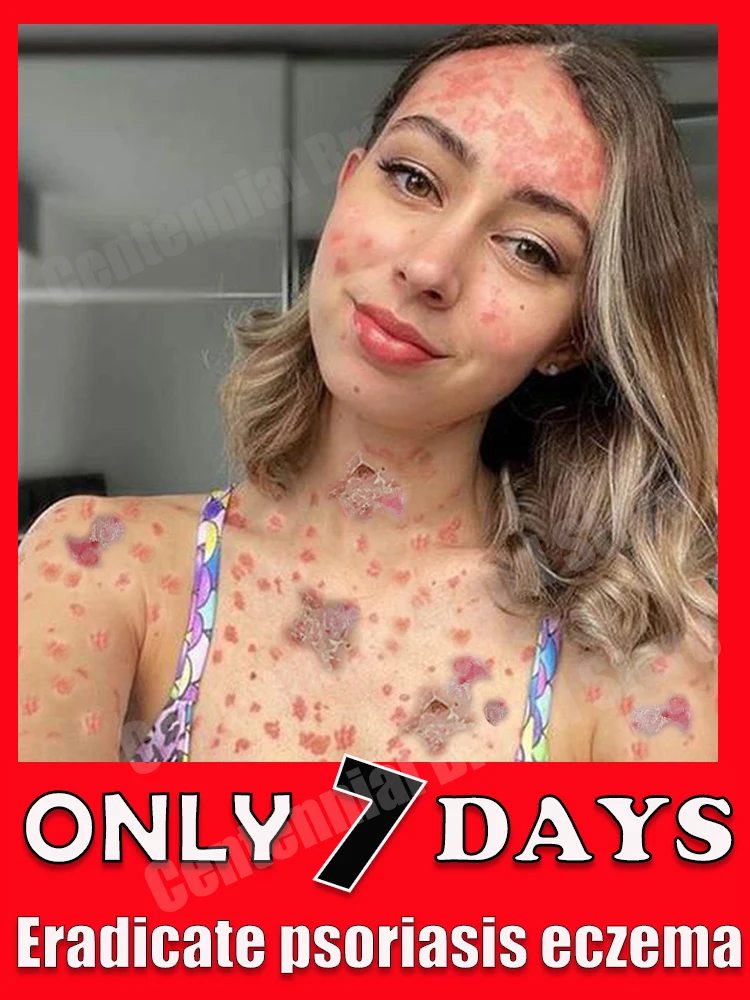

psoriasis cream Eczema Against Products