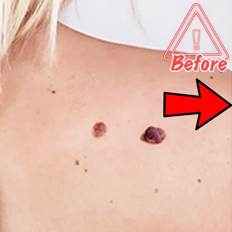 Морской невус на голове бородавки кожу головы обезьяне каулифтовая ручка