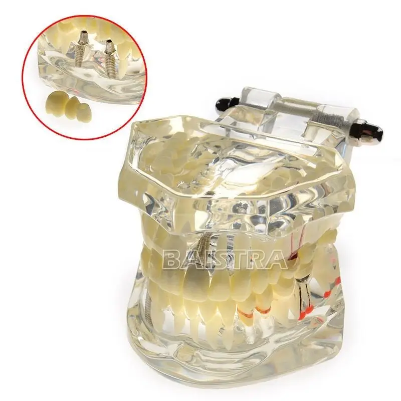 

New Dental Model Teeth Implant Restoration Bridge Teaching Study Medical Science Disease Dentist Dentistry Products