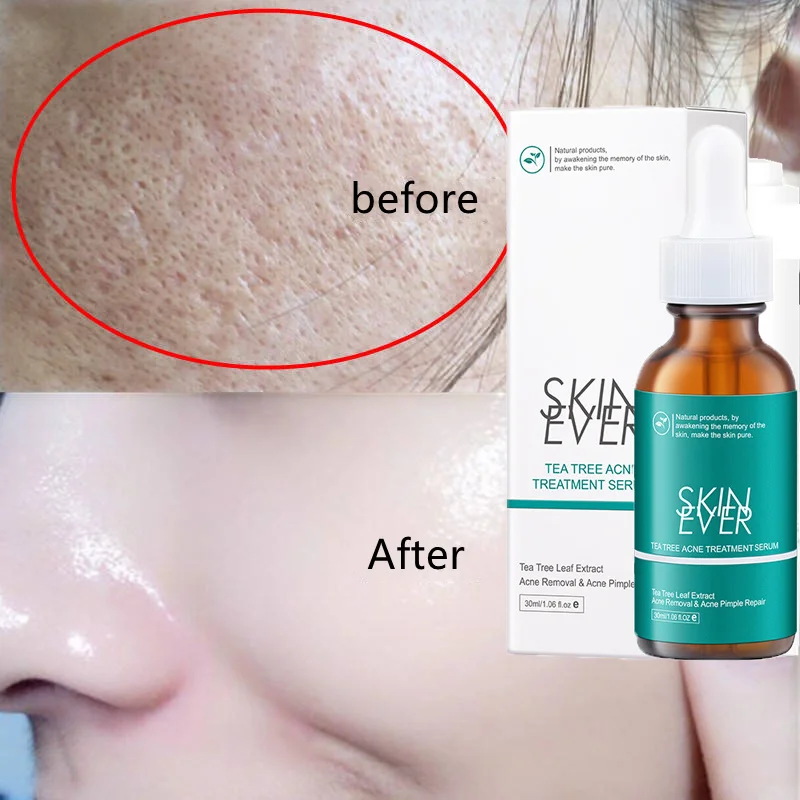 

Salicylic Acid Acne Treatment Face Serum Oil Contro Whitening Shrink Pores Remove Blackheads Essence Korean Cosmetics Skin Care