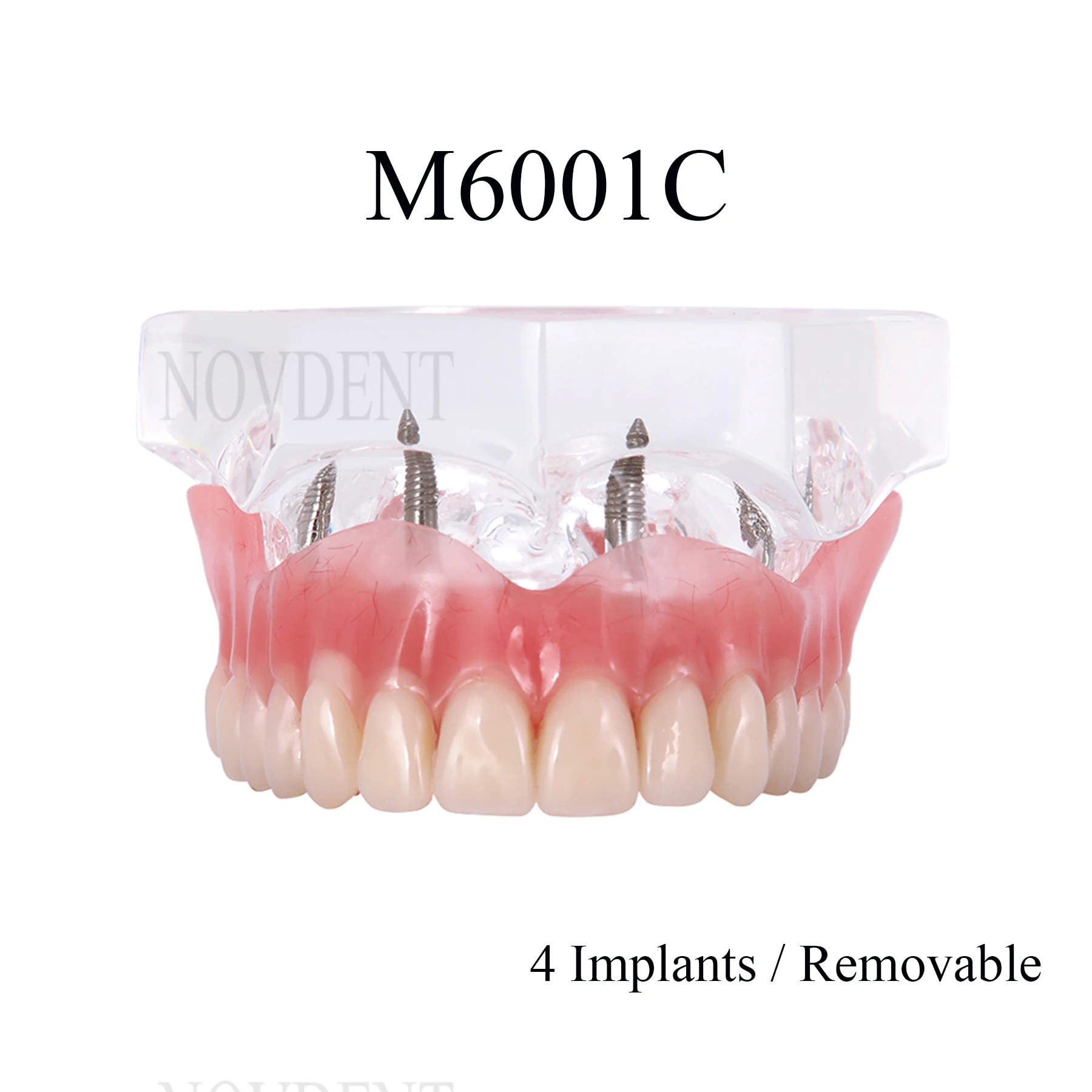 Стоматологическая верхняя челюсть 4 имплантатов модель для восстановления зубов
