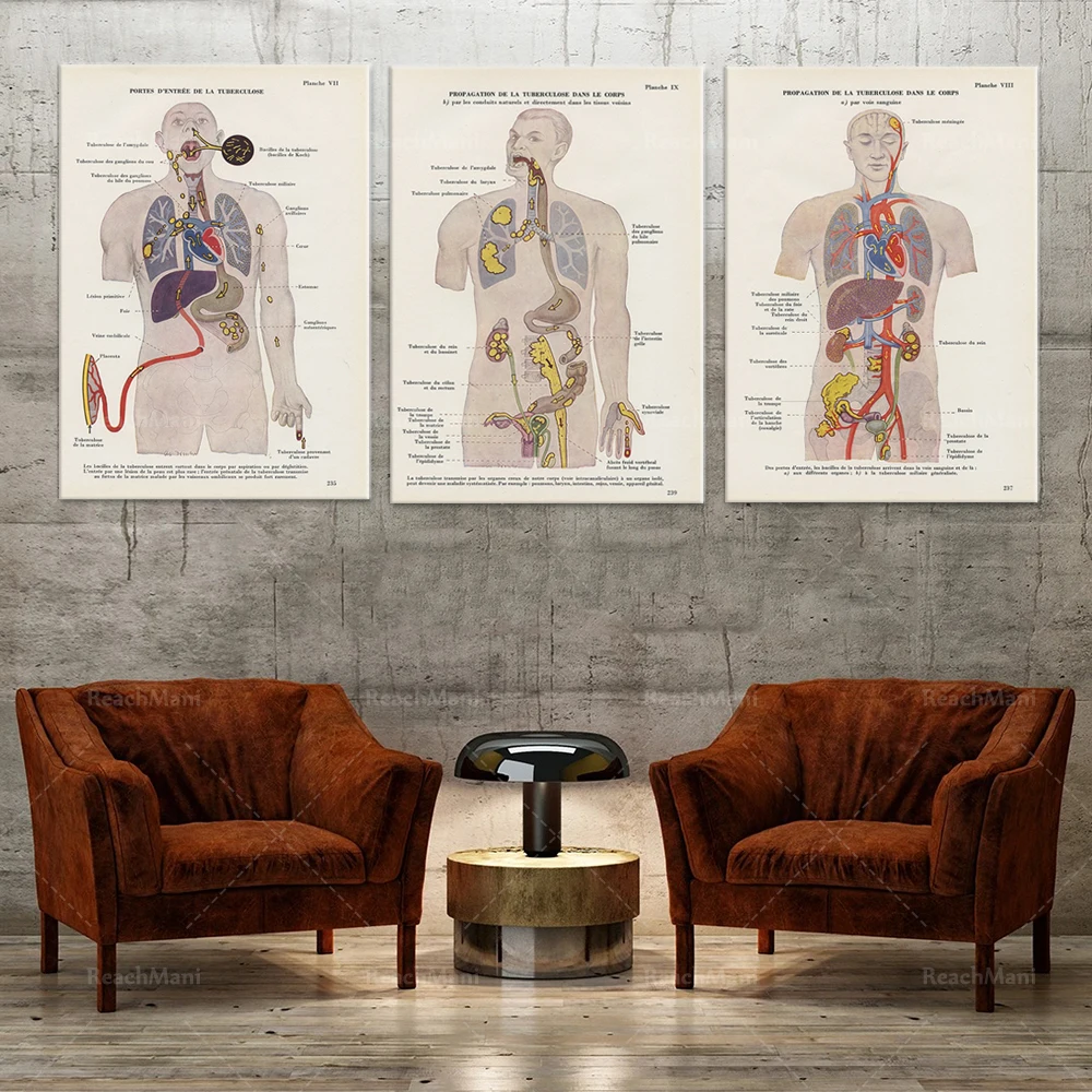 

Tuberculosis medical engraving from 1952. Vintage medical decorative anatomy poster. doctor's office decoration pulmonology gift