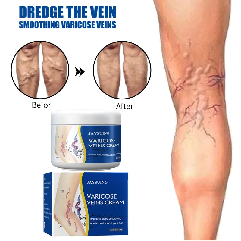 

Varicose Veins Treatment Cream Chinese Herbal Medicine Dilated Vasculitis Phlebitis Spider Leg Veins Pain Relief Ointment Care