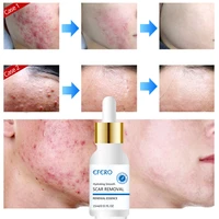 15ml acne scar remove essence blackhead face mask anti acne treatment whitening cream oil control shrink pores smooth face care