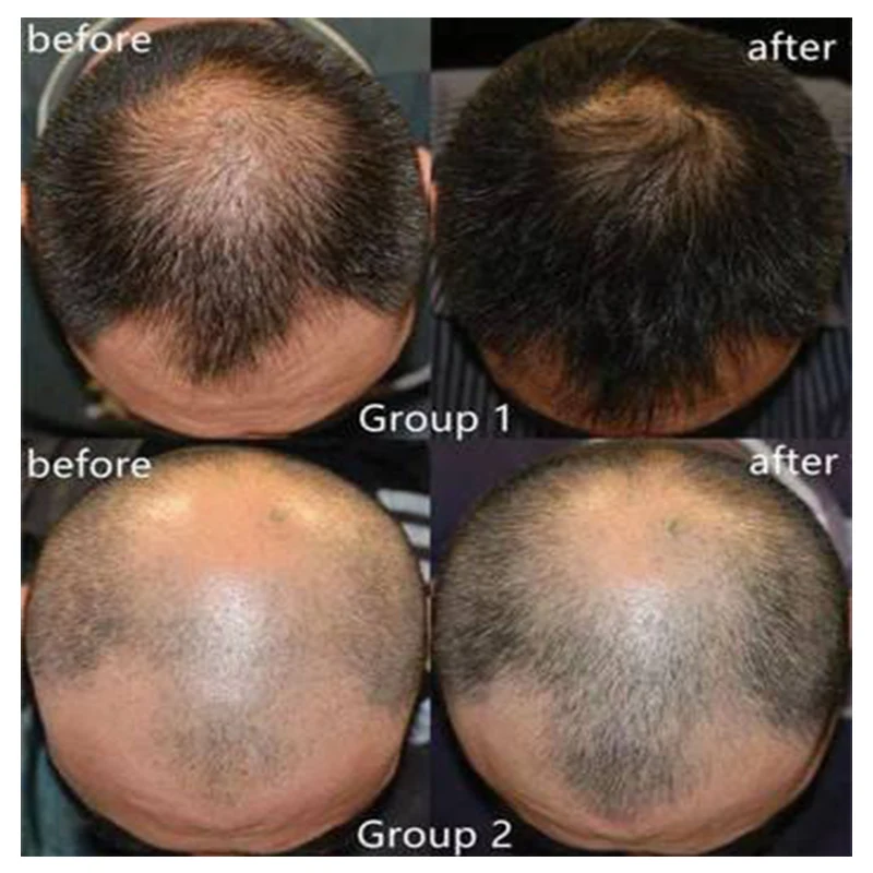 YOUNGCOME 60g 5 Days Hair Growth Ointment Promote Blood Circulation Protect Loss Control Oil Products |