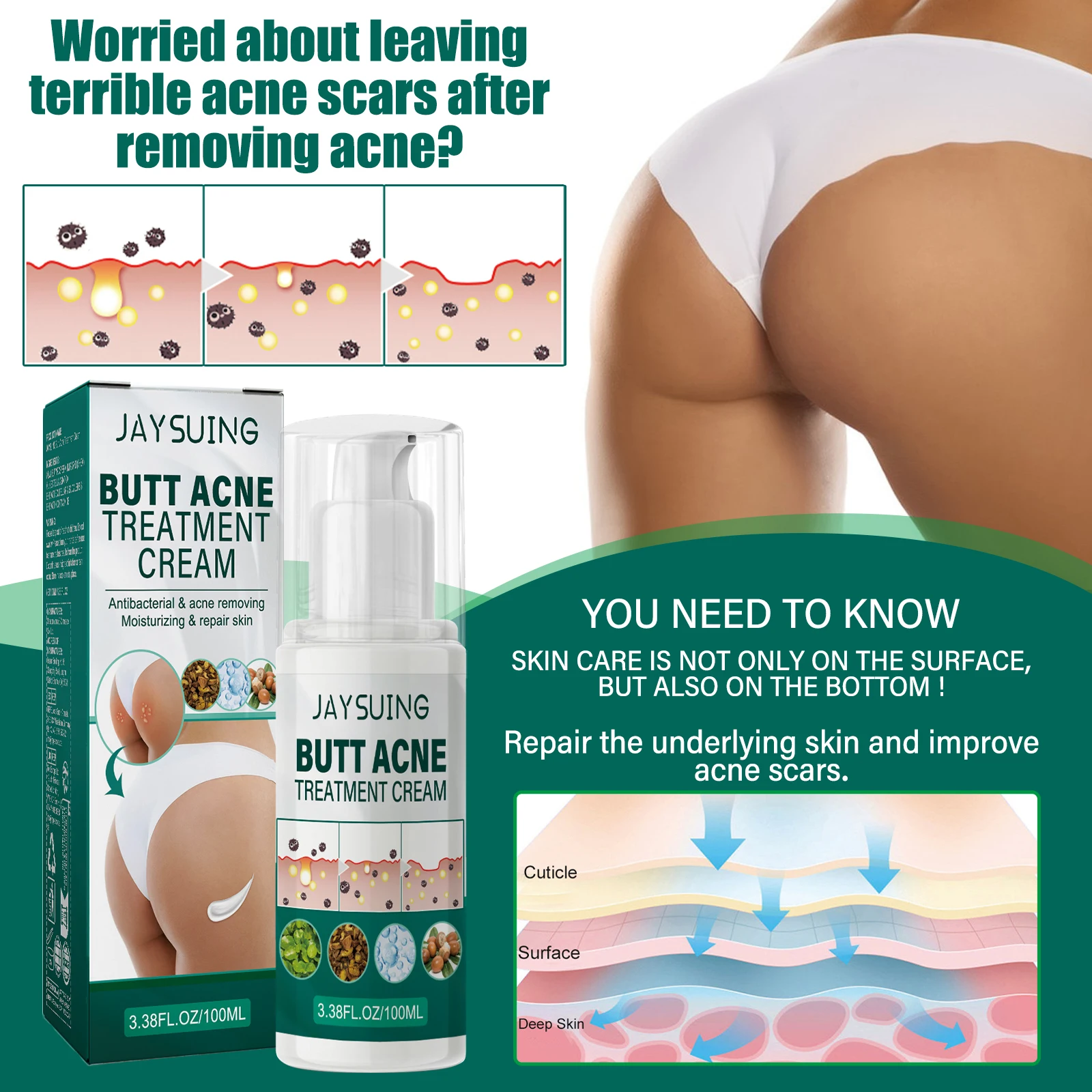 Крем для лечения ягодиц прыщей удаления ямок шрамов повреждений контроль масла