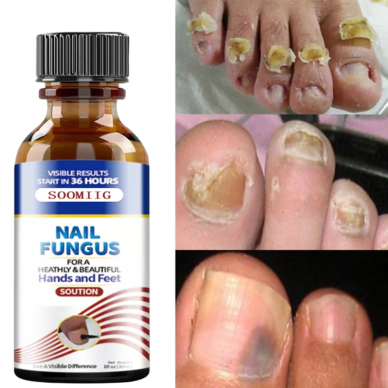 

Treatment Fungal Nail Essence Serum Care Repair Foot Nail Fungus Removal Gel Anti Infection Paronychia Onychomycosis Product