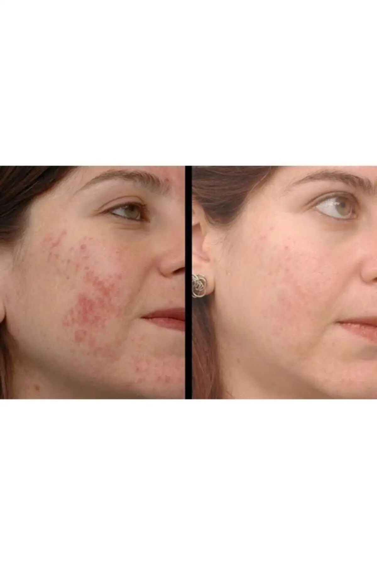 Crema para eliminar granos e imperfecciones de acn&eacute;, Original y para el cliente, eficaz, 30 gr-1