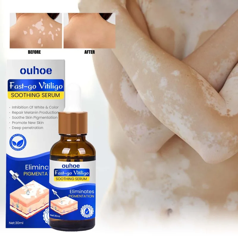 Сыворотка для лечения Vitiligo лампа роста пигмента Ringworm Tinea удаление пота и белых