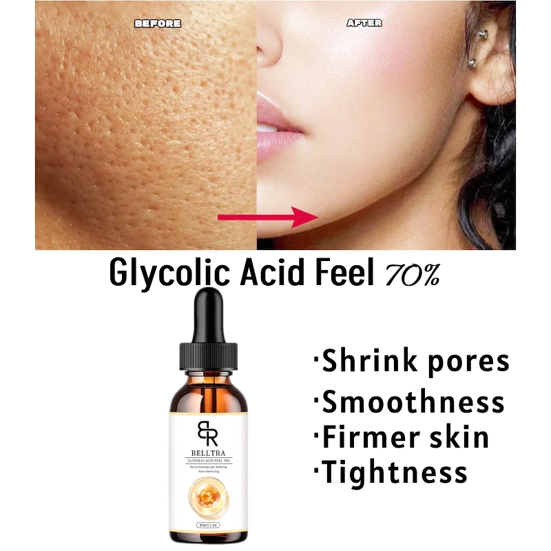 

70% Peeling Acid Smooths Fine Lines Pigmented Scars Skin Brightens 30ml