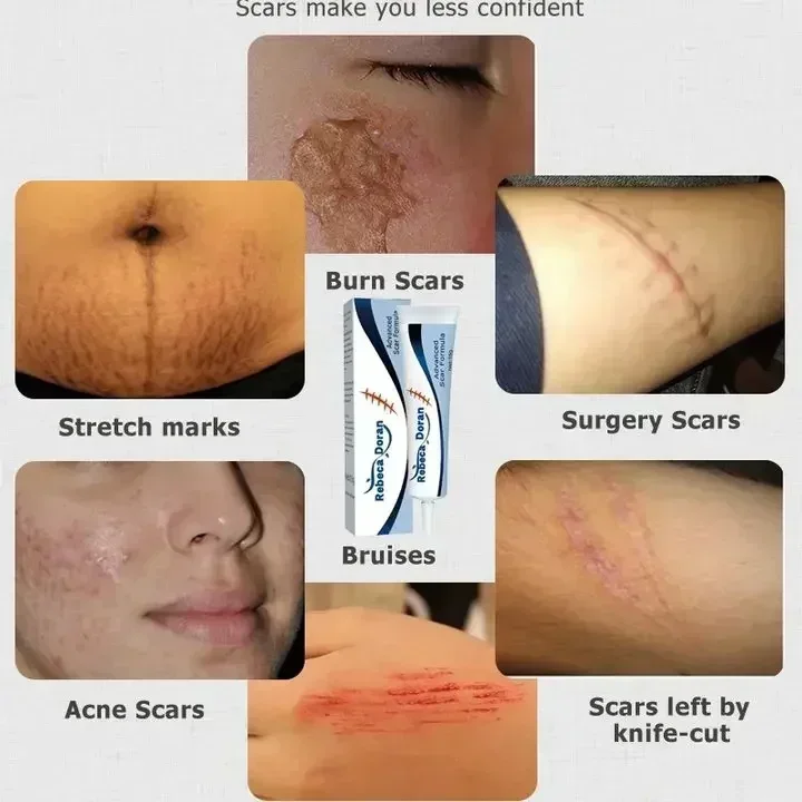 Средство для удаления растяжек после акне крем послеоперационного