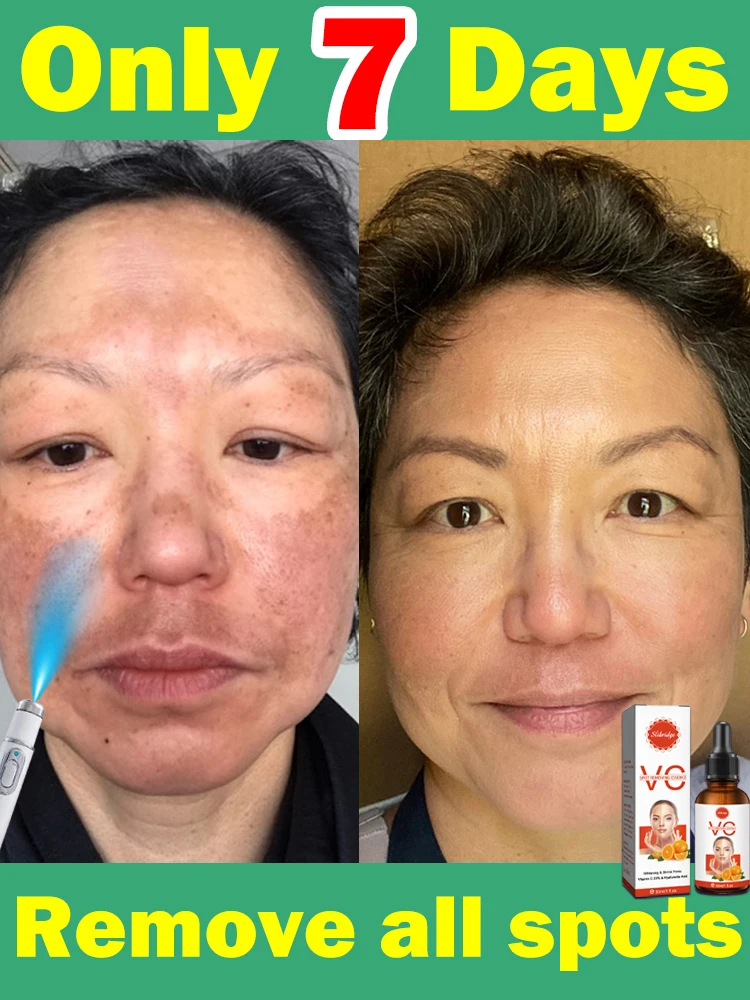 Темное солнечное пятно веснушки хлоазма прозрачная