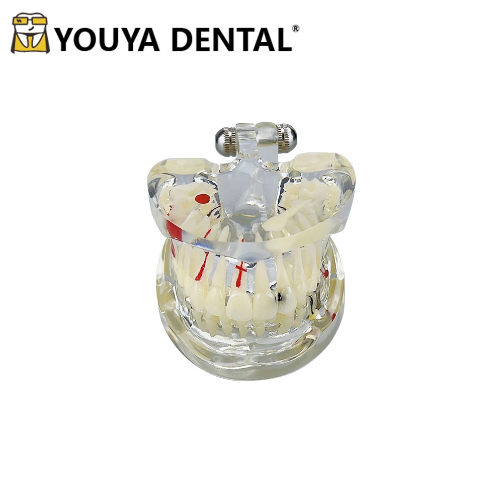 

Practice Model Adult Pathological with Implant Model For Dentist Student Clinics Oral Disease Studying Teaching Training Model