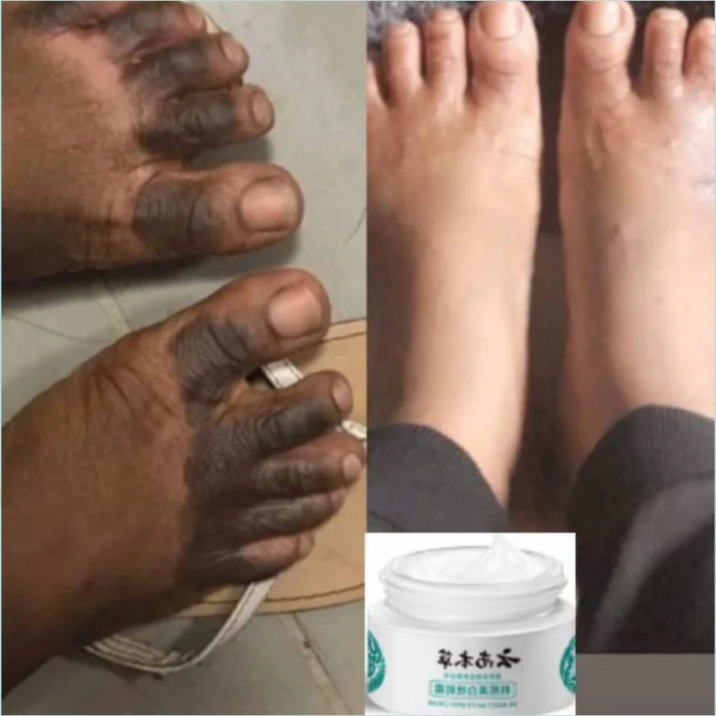 

Quick Whitening Cream Dark Neck Feet Underarms Elbows Melanin Powerful Armpit Removal Knee Bleaching Spots Lightening Skin Care